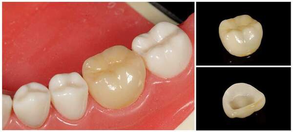 セラミックのつめ物