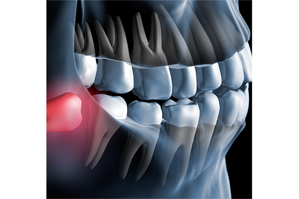 親知らずの痛みの原因