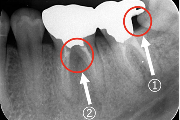 レントゲン写真（治療前）