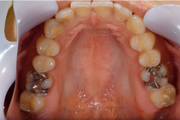 治療前（下から見た写真）