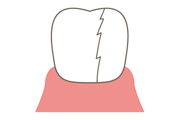 歯に亀裂が入っているイラスト