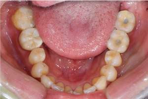 治療後（上から見た写真）