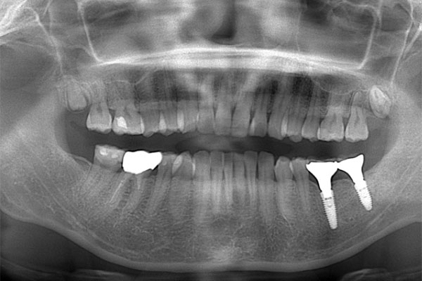 レントゲン写真（治療後）