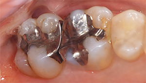 麻布十番歯科で虫歯症例の治療前の画像