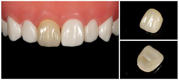 オールセラミッククラウン（スタンダード）