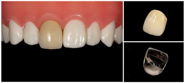 硬質レジン冠（前歯は保険適応）