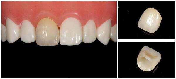 オールセラミッククラウン（プレミアム）