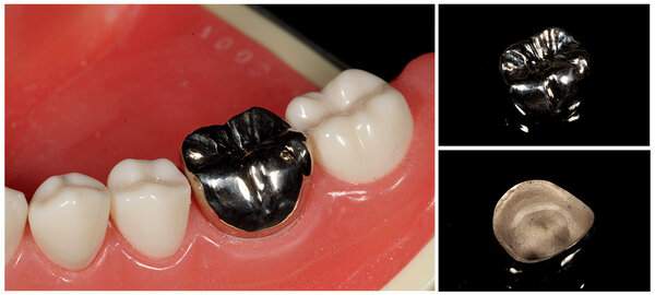 パラジュウムクラウン（銀歯）