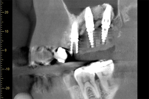 レントゲン写真全体（治療後）