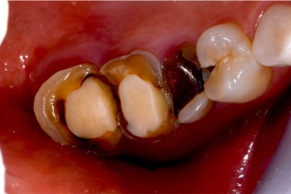 インプラント治療前