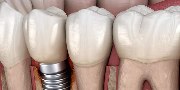 治療後のインプラントの周囲に炎症がある歯ぐきの断面のイメージ