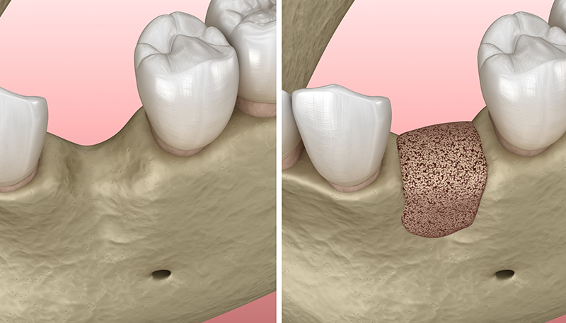 麻布十番の歯医者インプラント治療をで行う準備として骨誘導再生法のイメージ