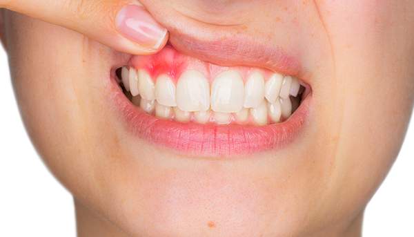 歯周病になってしまった人の歯ぐきのイメージ