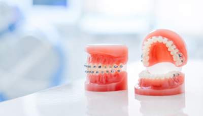 矯正装置を装着している歯の模型