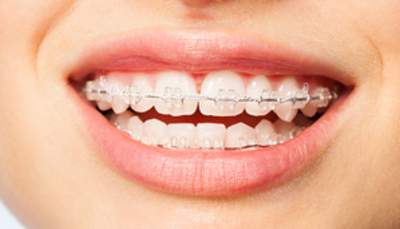 麻布十番の歯医者さんの矯正治療でブラケット装着後のイメージ