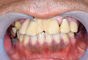 オールオン4治療前