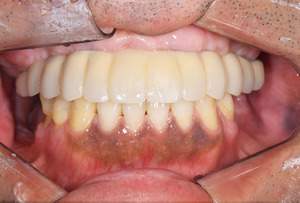 オールオン4治療後