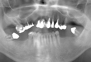 オールオン4治療前