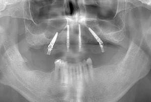 オールオン4治療後