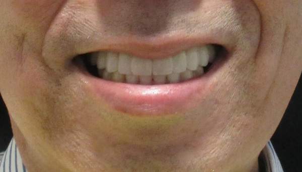 オールオン4治療後