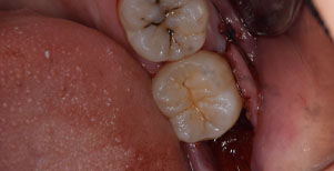 歯茎に埋まっている親知らず