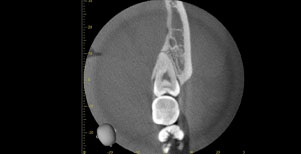歯茎に埋まっている親知らず