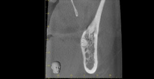 歯茎に埋まっている親知らず