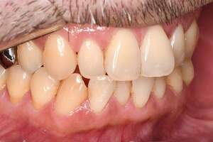 着色除去（PMTC）