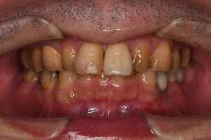 歯石除去（SC）