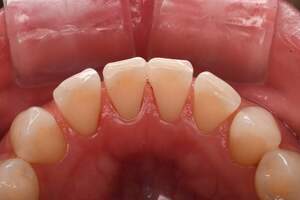 歯石除去（SC）