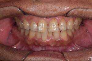 歯石除去（SC）