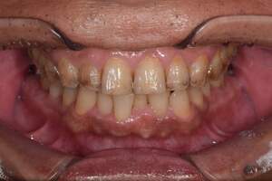 歯石除去（SC）