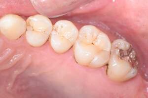 歯石除去（SC）