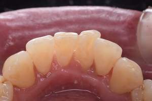 歯石除去（SC）