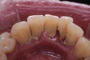 歯石除去（SC）