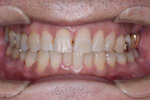 歯石除去（SC）