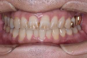 歯石除去（SC）