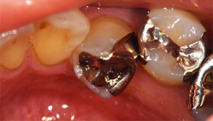 麻布十番の歯医者さんで銀歯を外す前の症例写真