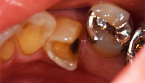 麻布十番の歯医者さんで銀歯を外す後の症例写真