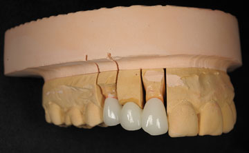 治療方法1：ブリッジ