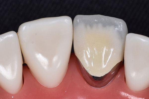 メタルボンドクラウン