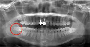 抜くと痛みや腫れが出やすい横向きで生えている親知らず症例のレントゲン写真