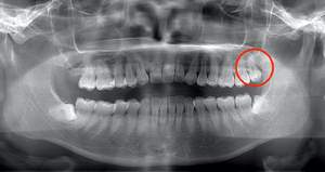 抜歯が簡単で、痛みが出にくい真っ直ぐ生えている親知らず症例のレントゲン写真