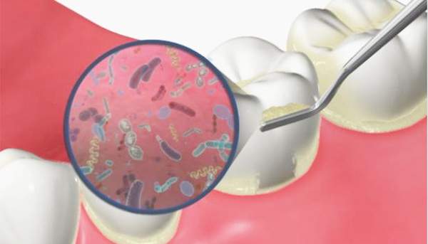 プラークがついている歯のイメージ