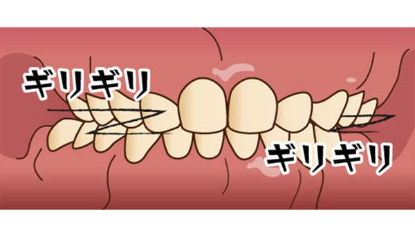 食いしばり・歯ぎしりのイラスト
