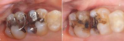 麻布十番歯科で銀歯が虫歯になってしまった症例の口腔内写真