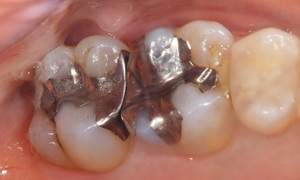 麻布十番歯科で銀歯の症例の口腔内写真