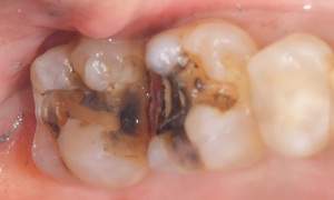 麻布十番歯科で銀歯の中が虫歯になっている症例の口腔内写真