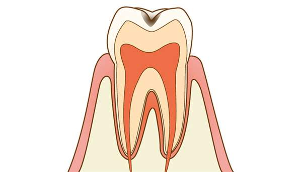 虫歯になり始めの歯の断面図のイラスト