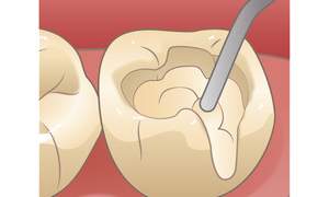 取り除いて空いた部分にCRを注いでいるイラスト